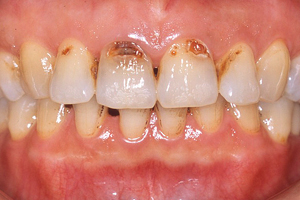 虫歯をオールセラミックで修復した症例